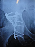 Ortopedik Deformite Cerrahisi